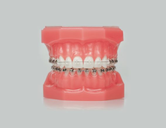 Damon® Clear Braces