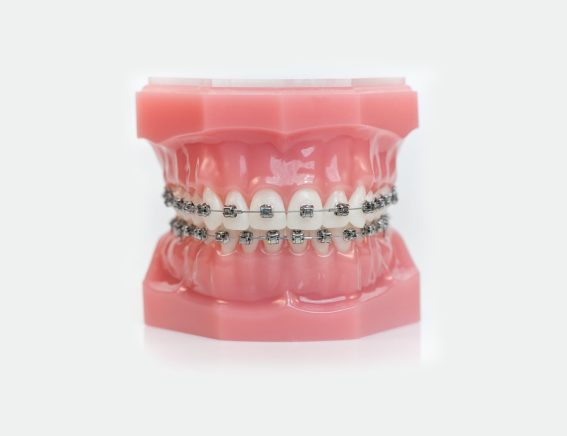 Damon® Metal Braces