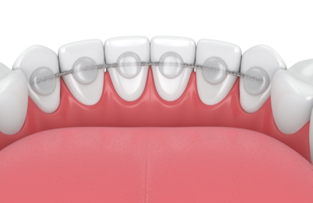 fixed-retainer-stock-photo