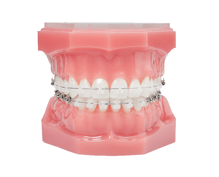 DamonClear_Braces